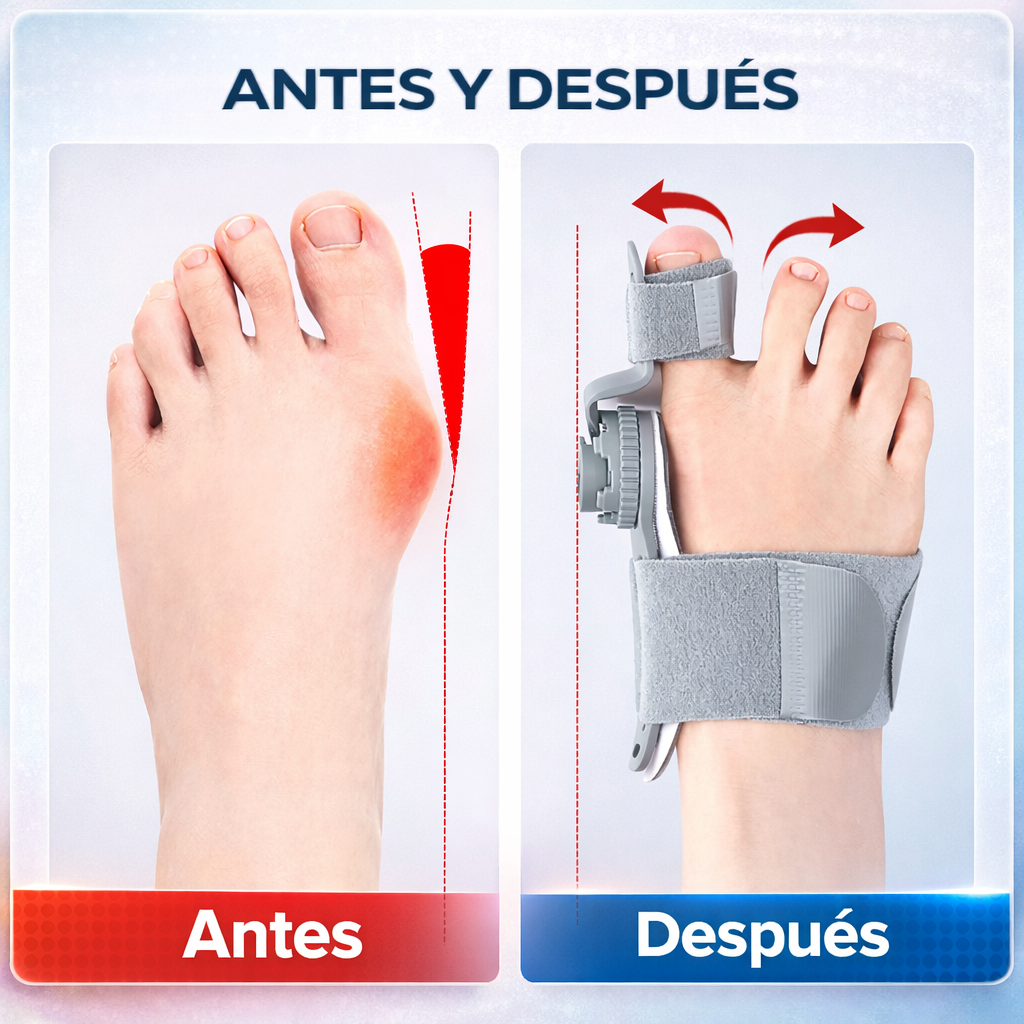 Corrector de Juanetes FeetFix™ – Ajuste gradual del dedo – Ayuda a aliviar molestias y mejorar la postura del pie en semanas